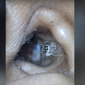 Mulher descobre que tinha aranha no ouvido após sofrer com dores de cabeça