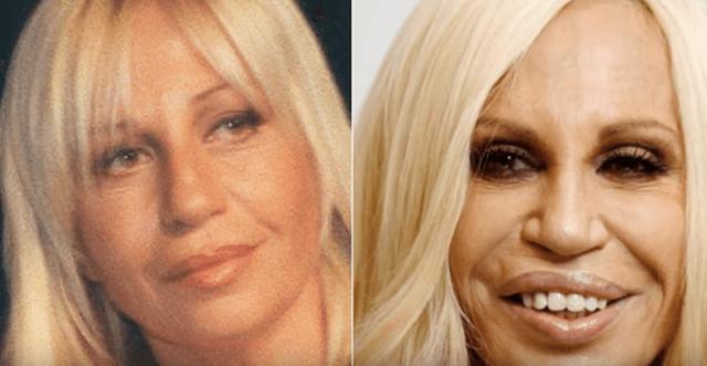Before And After Photos Of The Craziest Celebrity Plastic Surgery Disasters国际蛋蛋赞 
