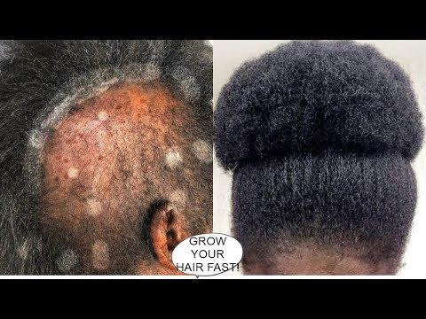 Your Hair Will Grow Like Crazy Grow Hair Long Thick Healthy Fast