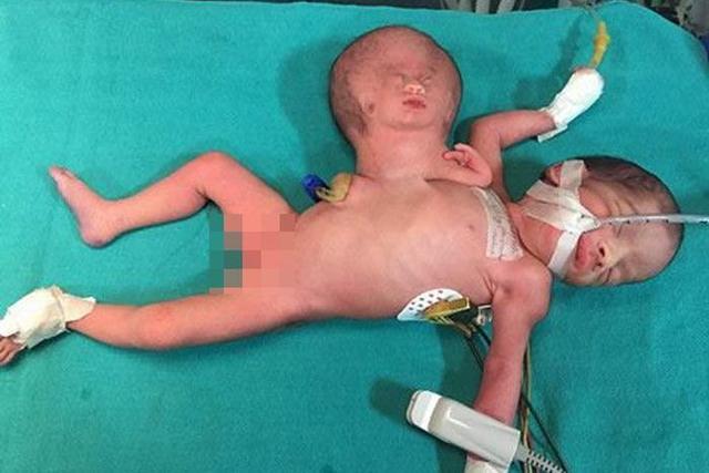 Bebê nasce com cabeça de 'gêmeo parasita' no corpo e realiza cirurgia