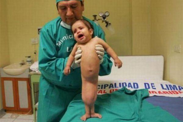 15 Unfortunate Children Suffered Really Weird Diseases You ...