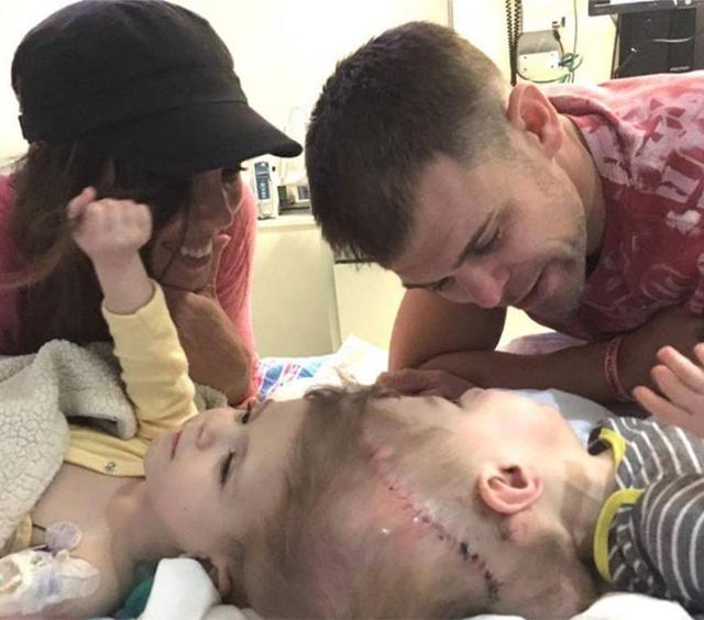 Twins Joined At The Top Of Their Head Finally Separated! See The After Pictures!