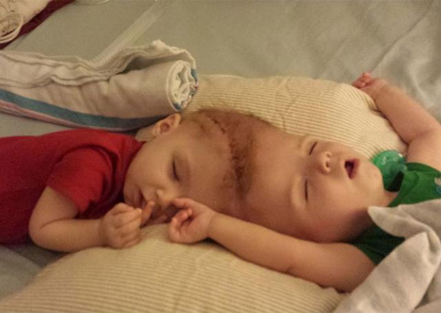 Twins Joined At The Top Of Their Head Finally Separated! See The After Pictures!