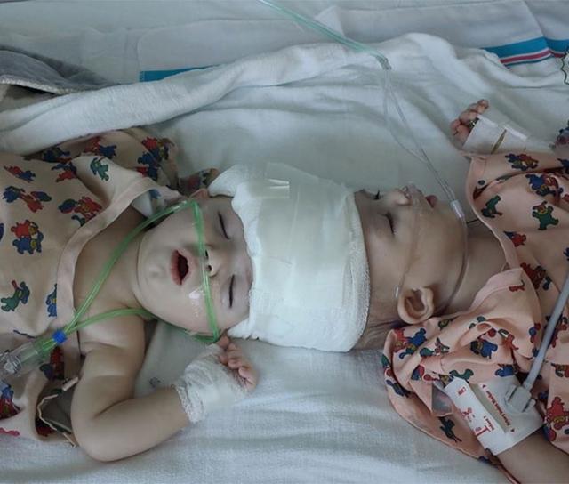 Twins Joined At The Top Of Their Head Finally Separated! See The After Pictures!