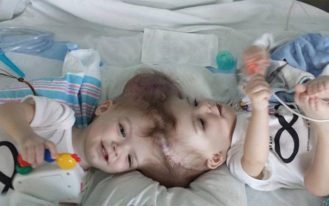 Twins Joined At The Top Of Their Head Finally Separated! See The After Pictures!