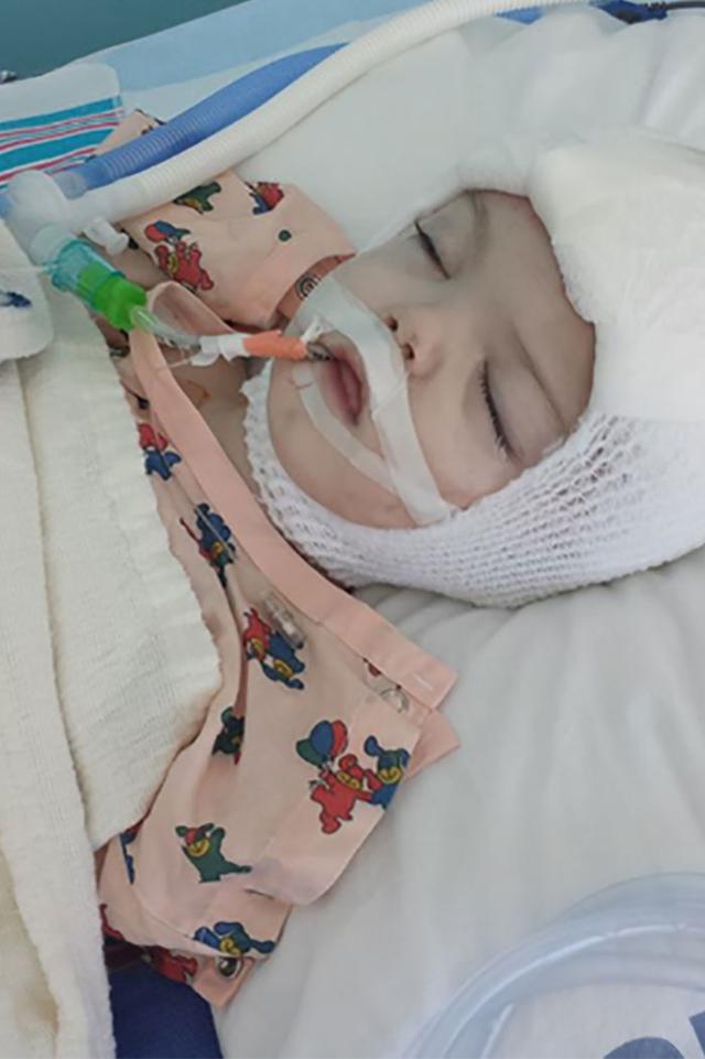 Twins Joined At The Top Of Their Head Finally Separated! See The After Pictures!