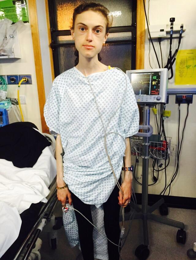 Anorexic Girl Who Refused To Sit Down During The Day To Burn More Calories Battles Her Way Back 国际 蛋蛋赞