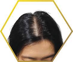 How To Use Black Seed Oil For Hair Growth And Baldness å›½é™… è›‹è›‹èµž