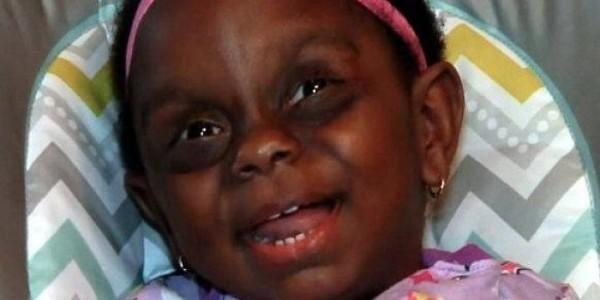 Mom Posts A Picture Of Her Baby With Rare Disorder On Facebook, Becomes Victim Of Cyberbullying