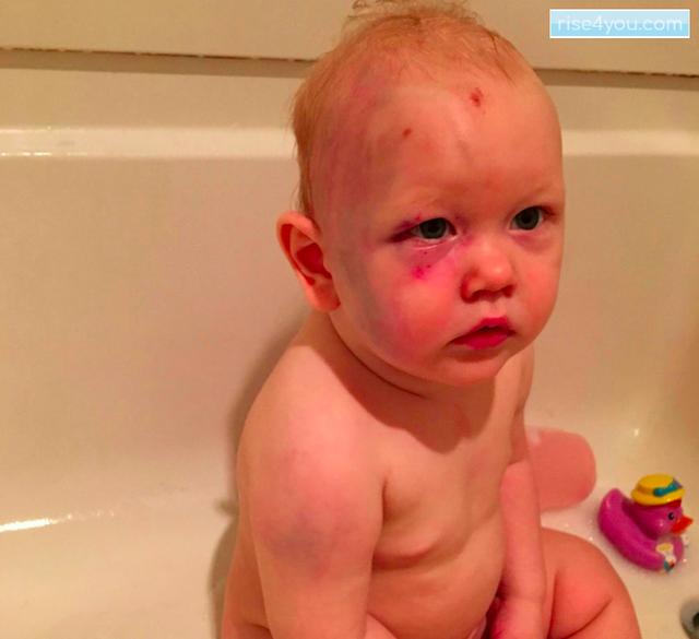Parents wake up to find son covered in bruises, then dad sees a handprint on his child’s face