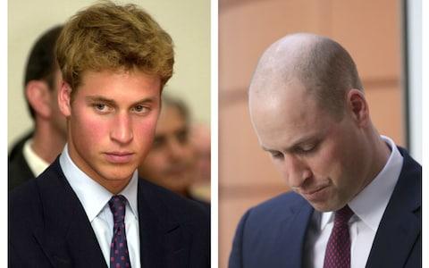 4 Celebrities Who Either Lost Or Are Losing Their Hair 国际 蛋蛋赞