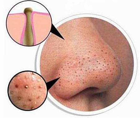 The Natural And Fast Way To Overcome The Stubborn Black Blackheads