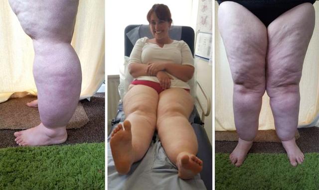 Lipedema ejercicios